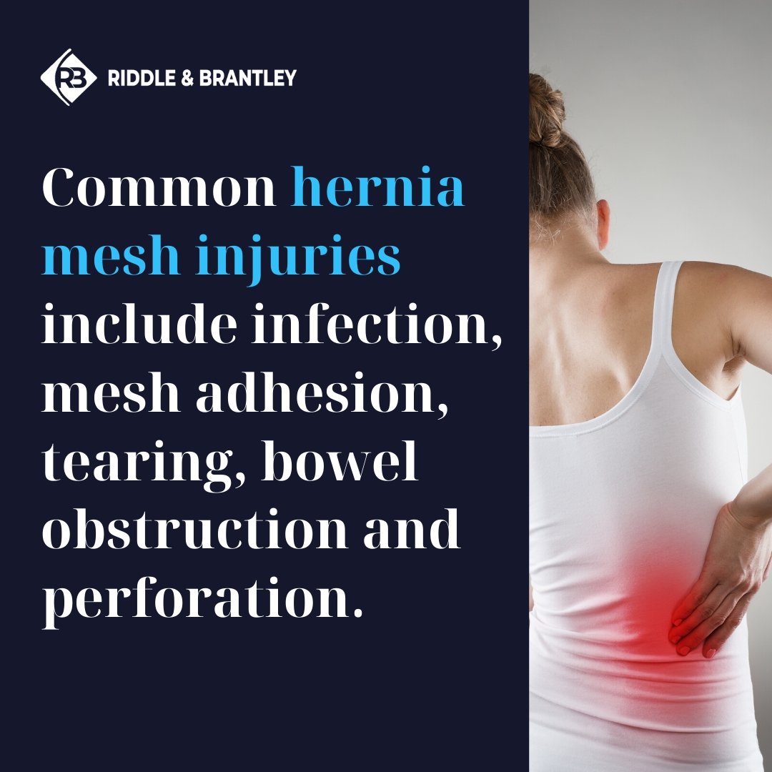 Hernia Mesh Claims for Injuries - Riddle & Brantley