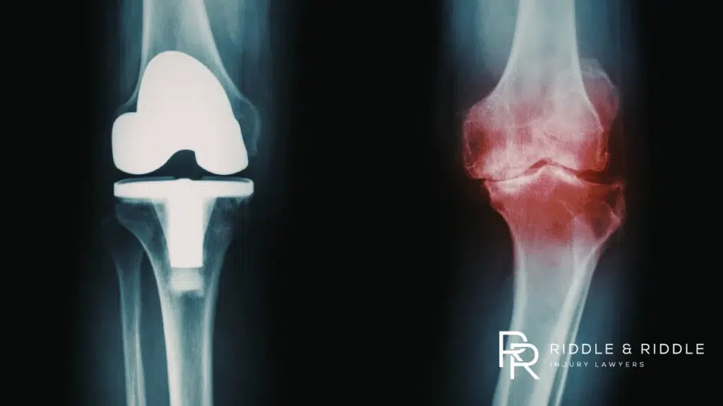 Medical X-ray showing prosthetic metal implants from a total knee replacement surgery
